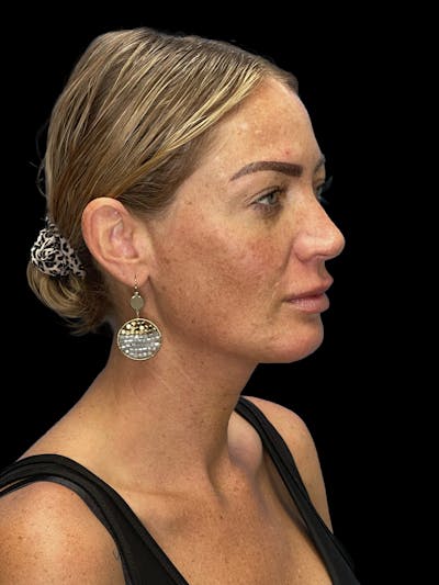 Chin Implant Before & After Gallery - Patient 241284 - Image 2
