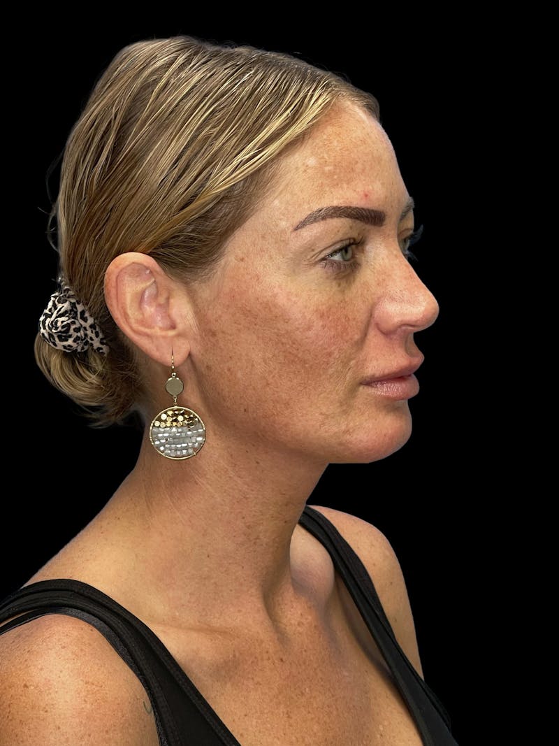 Chin Implant Before & After Gallery - Patient 241284 - Image 2