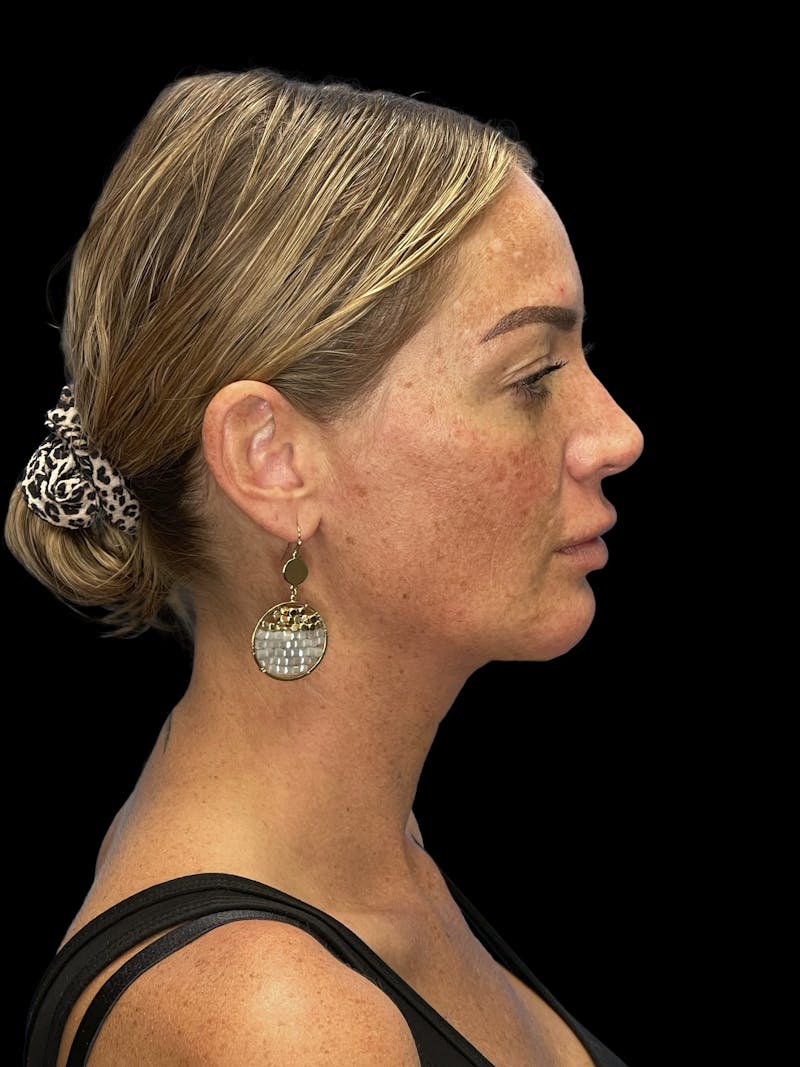 Chin Implant Before & After Gallery - Patient 241284 - Image 4