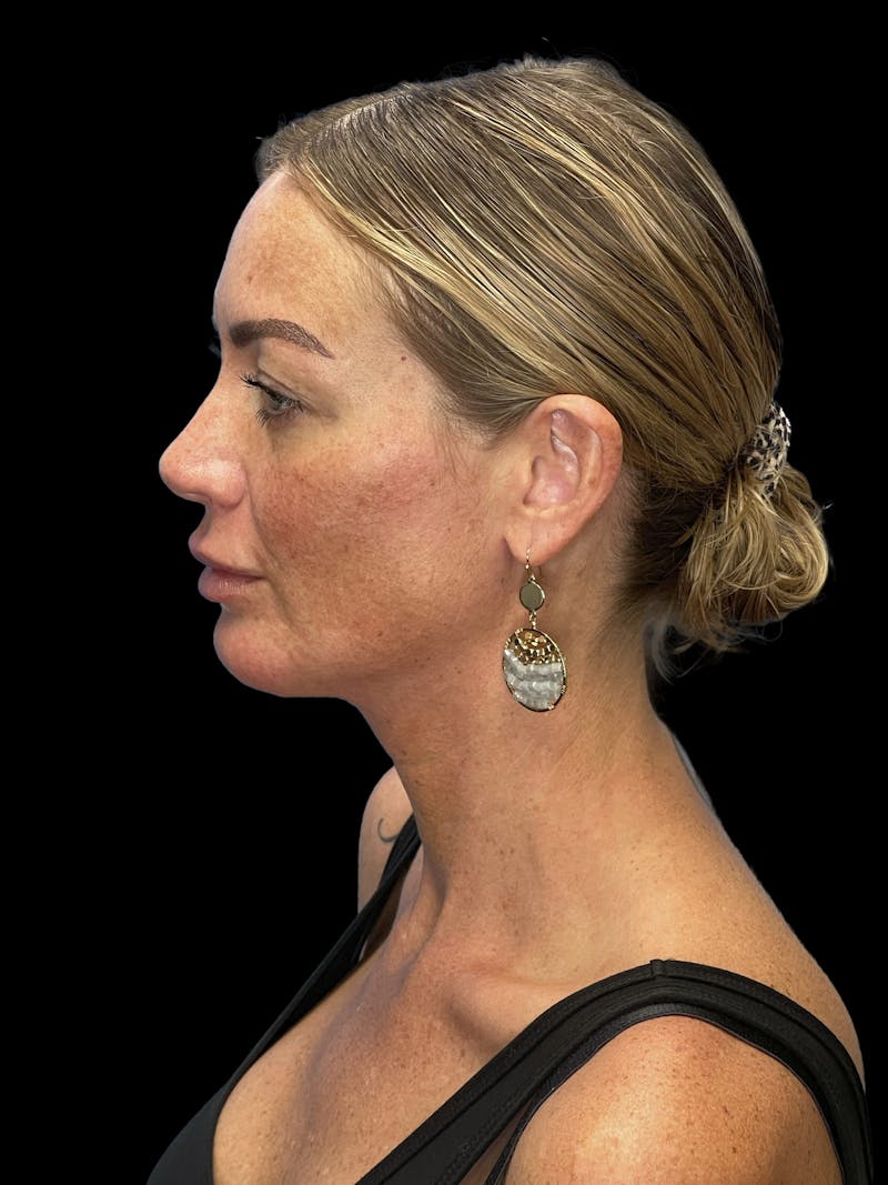 Chin Implant Before & After Gallery - Patient 241284 - Image 8