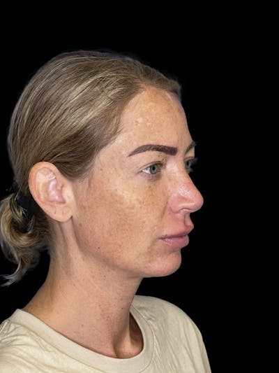 Chin Implant Before & After Gallery - Patient 241284 - Image 1