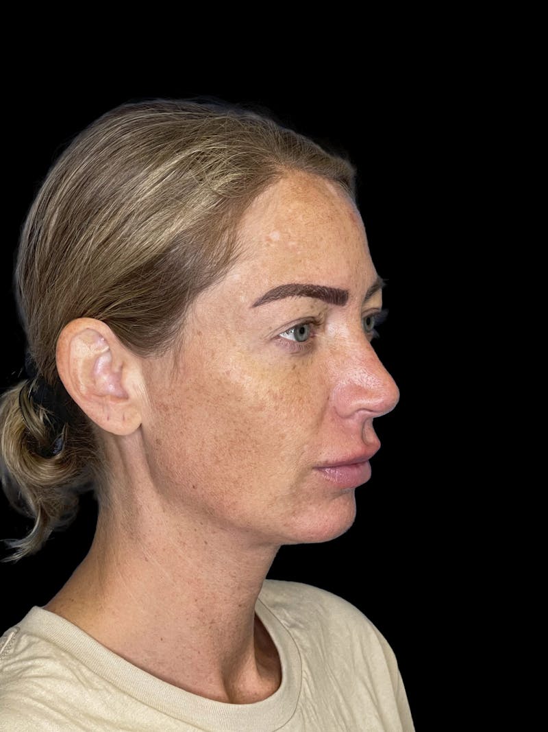 Chin Implant Before & After Gallery - Patient 241284 - Image 1