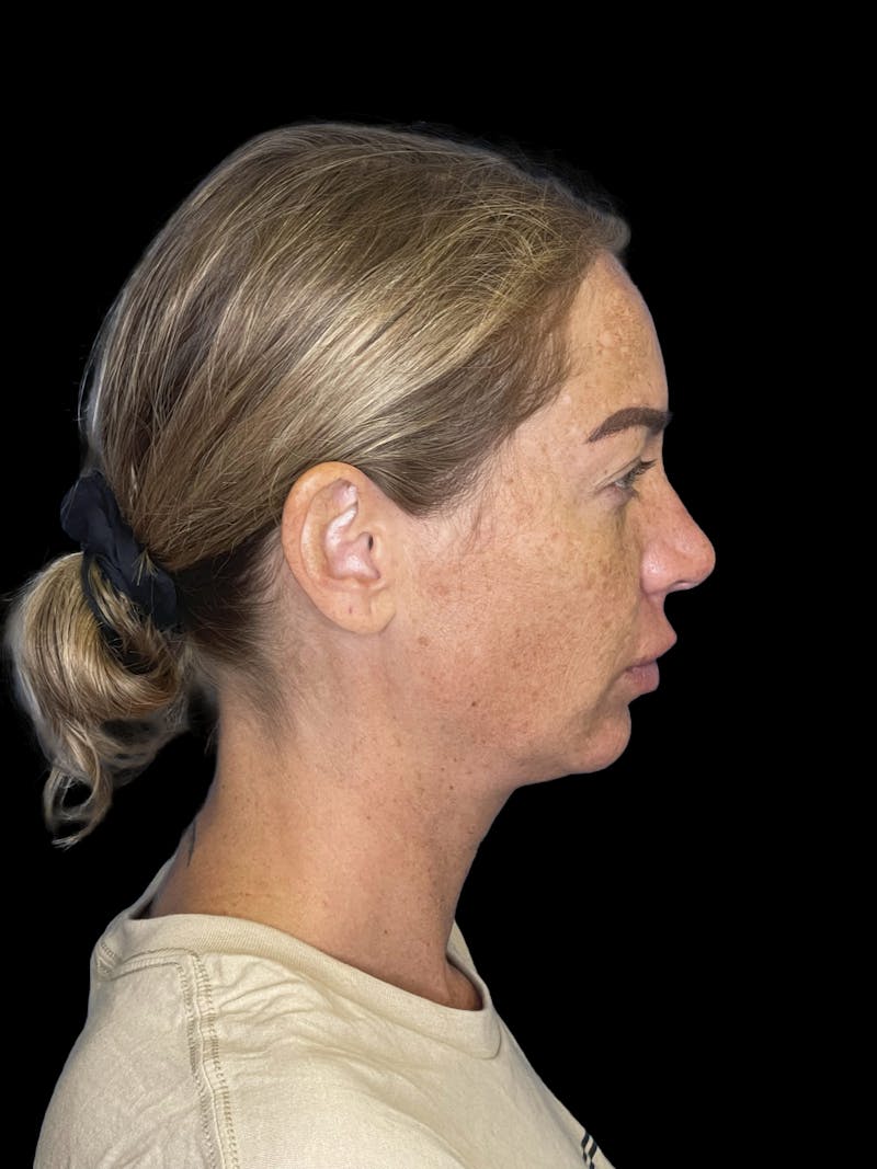 Chin Implant Before & After Gallery - Patient 241284 - Image 3