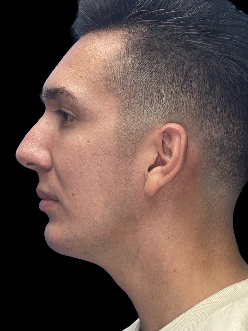 Chin Implant Before & After Gallery - Patient 370084 - Image 8