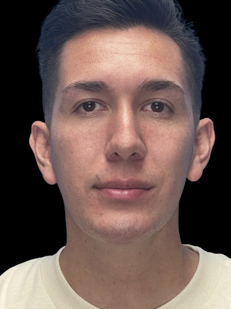 Chin Implant Before & After Gallery - Patient 370084 - Image 2