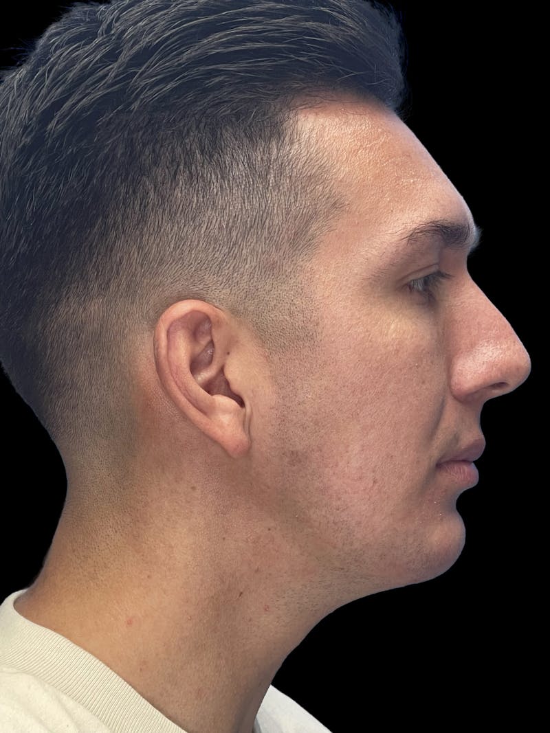 Chin Implant Before & After Gallery - Patient 370084 - Image 10