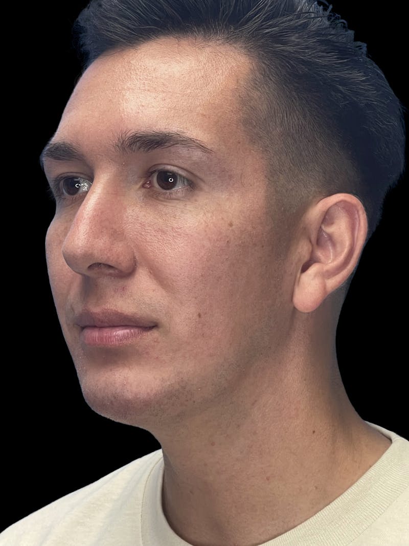Chin Implant Before & After Gallery - Patient 370084 - Image 6