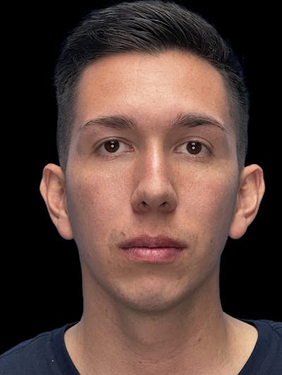 Chin Implant Before & After Gallery - Patient 370084 - Image 1