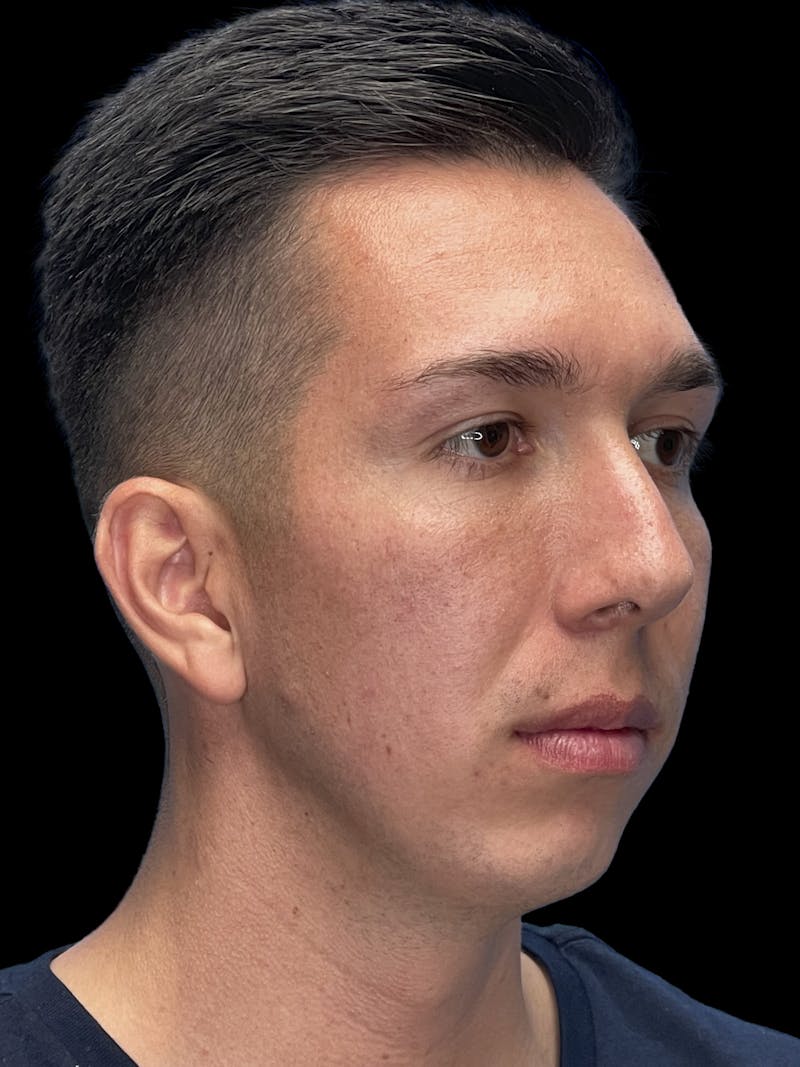 Chin Implant Before & After Gallery - Patient 370084 - Image 3