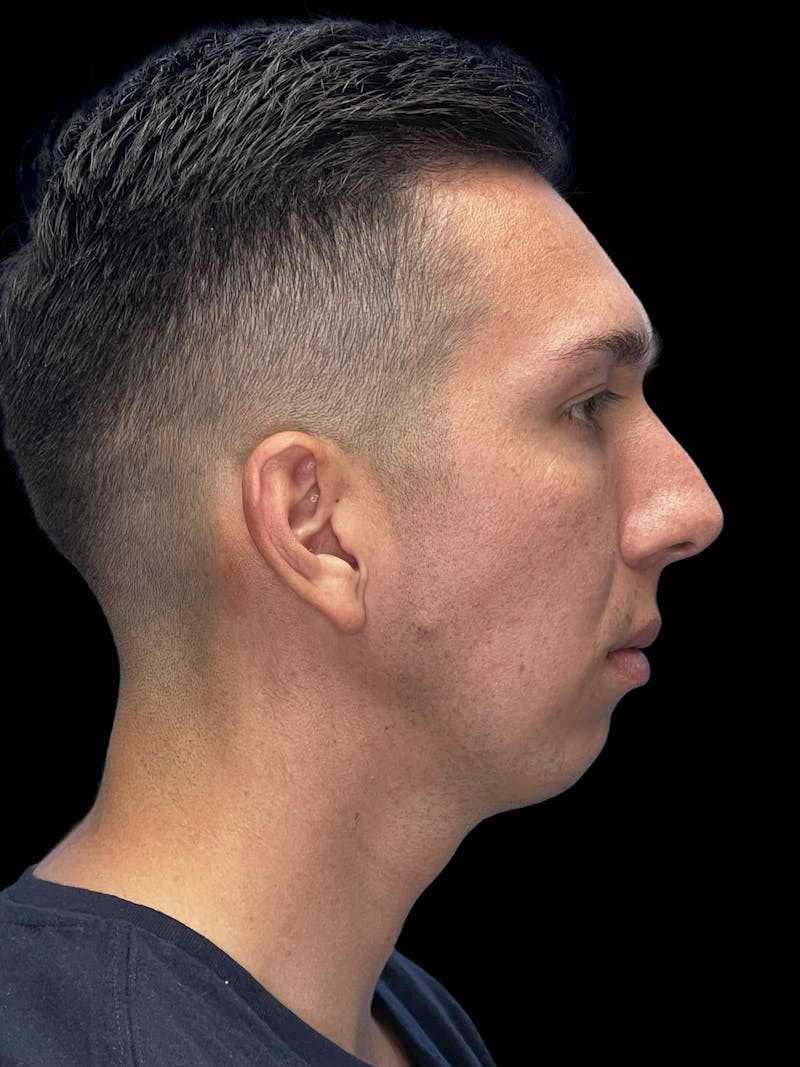Chin Implant Before & After Gallery - Patient 370084 - Image 9