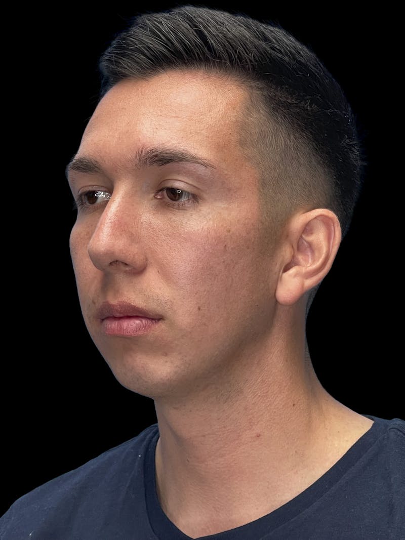 Chin Implant Before & After Gallery - Patient 370084 - Image 5