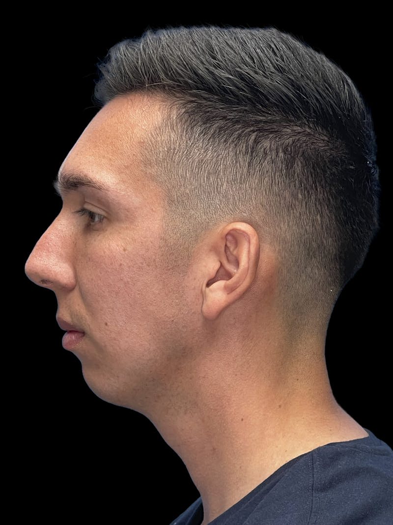 Chin Implant Before & After Gallery - Patient 370084 - Image 7