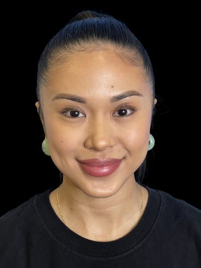 Chin Implant Before & After Gallery - Patient 396185 - Image 2