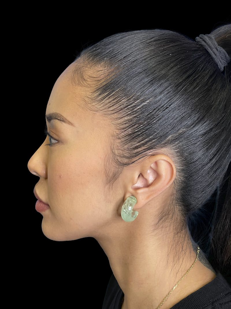 Chin Implant Before & After Gallery - Patient 396185 - Image 6