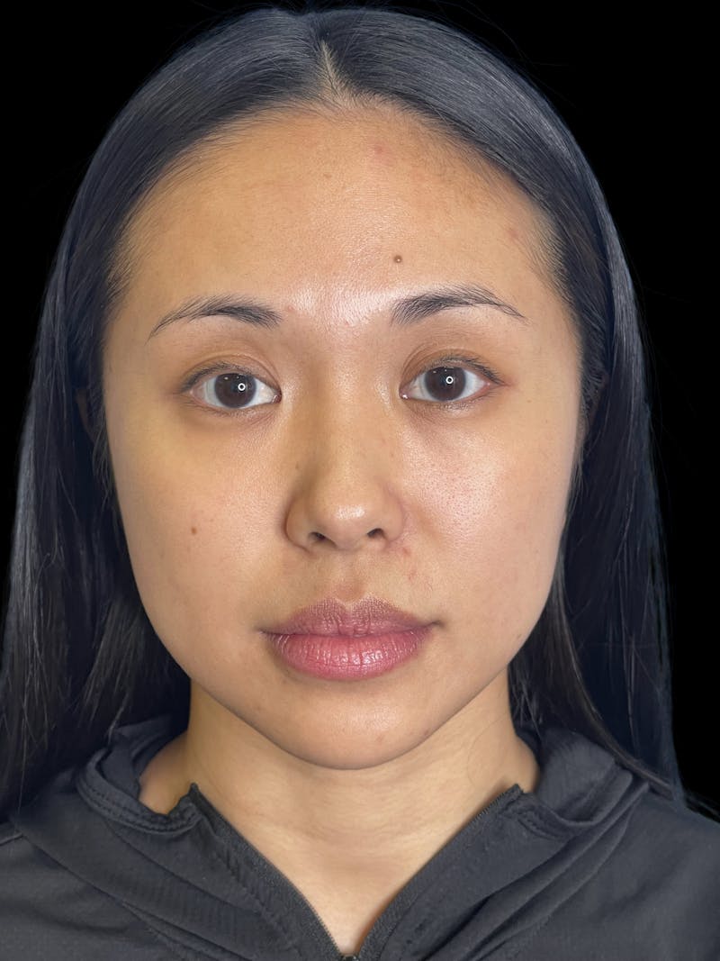 Chin Implant Before & After Gallery - Patient 396185 - Image 1