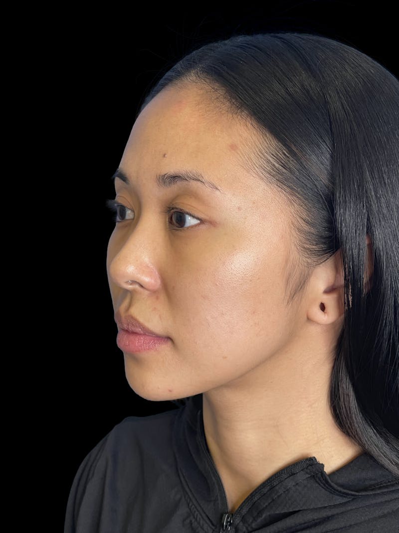 Chin Implant Before & After Gallery - Patient 396185 - Image 3