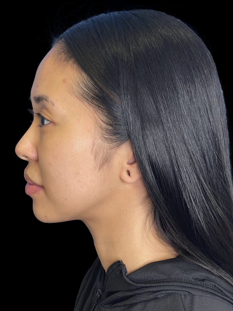 Chin Implant Before & After Gallery - Patient 396185 - Image 5