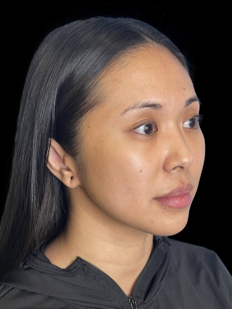 Chin Implant Before & After Gallery - Patient 396185 - Image 7