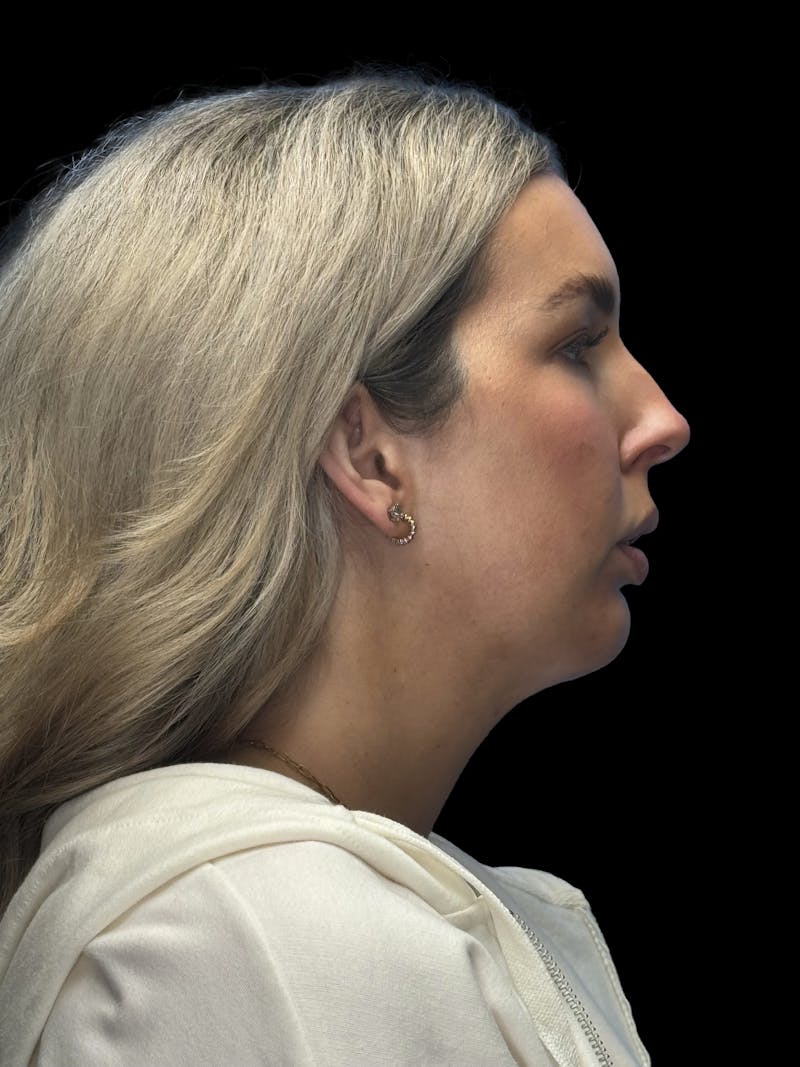 Chin Implant Before & After Gallery - Patient 320648 - Image 10