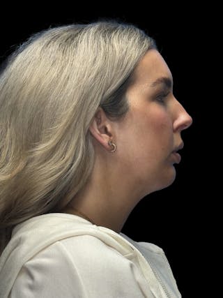 Chin Implant Before & After Gallery - Patient 320648 - Image 10