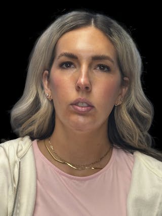 Chin Implant Before & After Gallery - Patient 320648 - Image 2