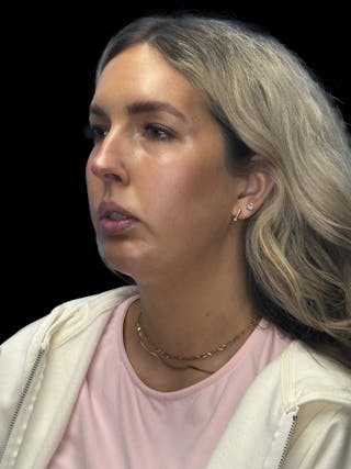 Chin Implant Before & After Gallery - Patient 320648 - Image 4