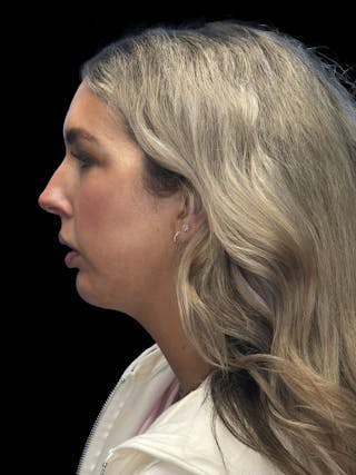 Chin Implant Before & After Gallery - Patient 320648 - Image 6