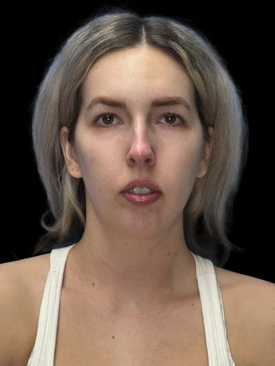 Chin Implant Before & After Gallery - Patient 320648 - Image 1