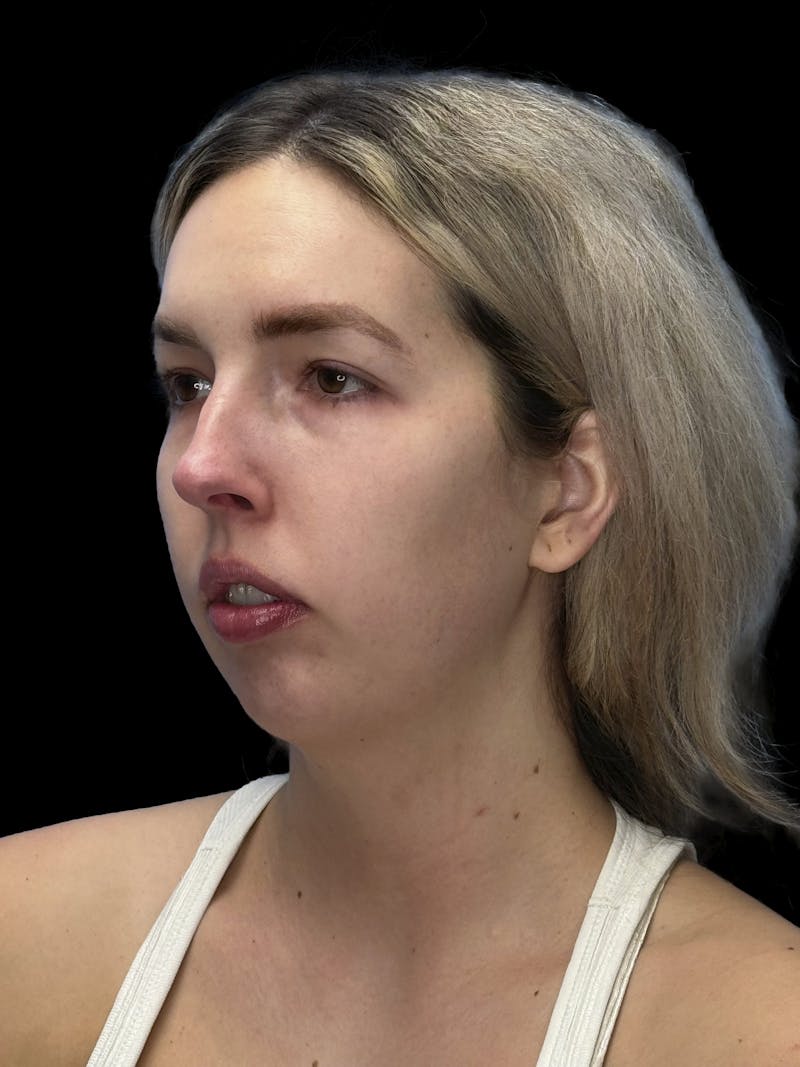 Chin Implant Before & After Gallery - Patient 320648 - Image 3