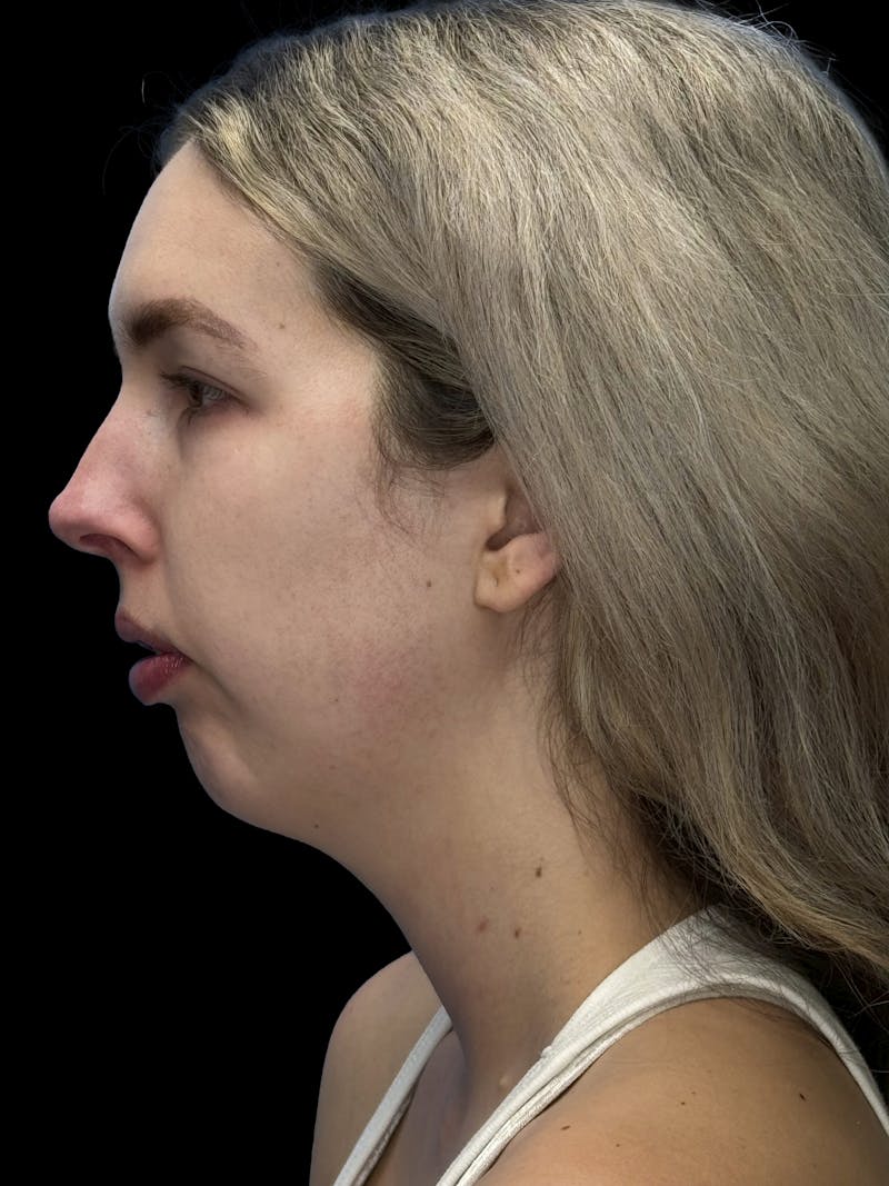 Chin Implant Before & After Gallery - Patient 320648 - Image 5