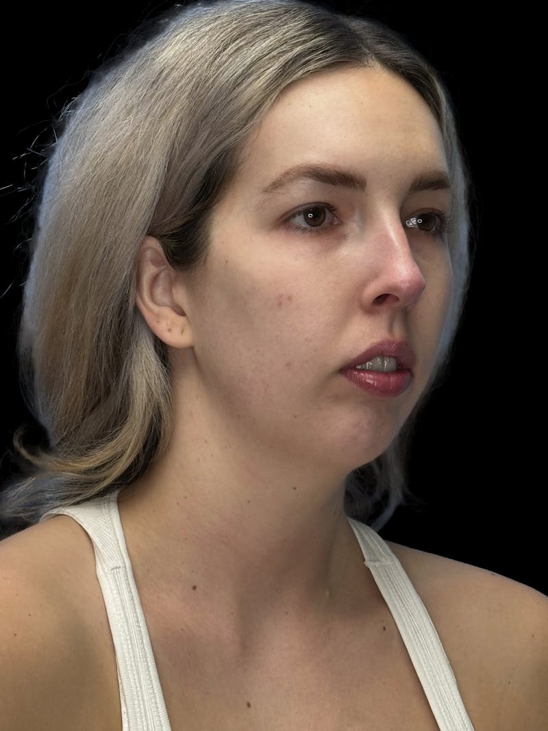 Chin Implant Before & After Gallery - Patient 320648 - Image 7