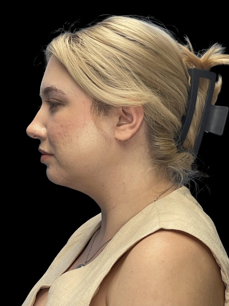 Chin Implant Before & After Gallery - Patient 746472 - Image 8