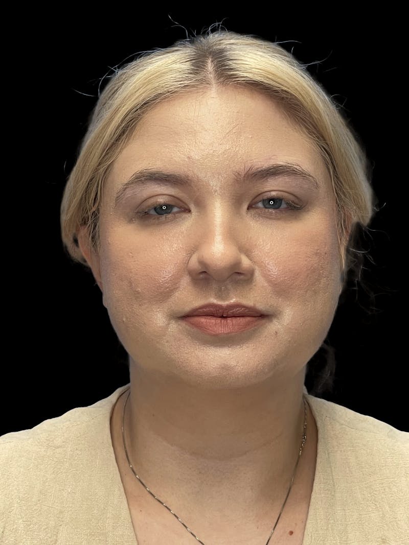 Chin Implant Before & After Gallery - Patient 746472 - Image 2