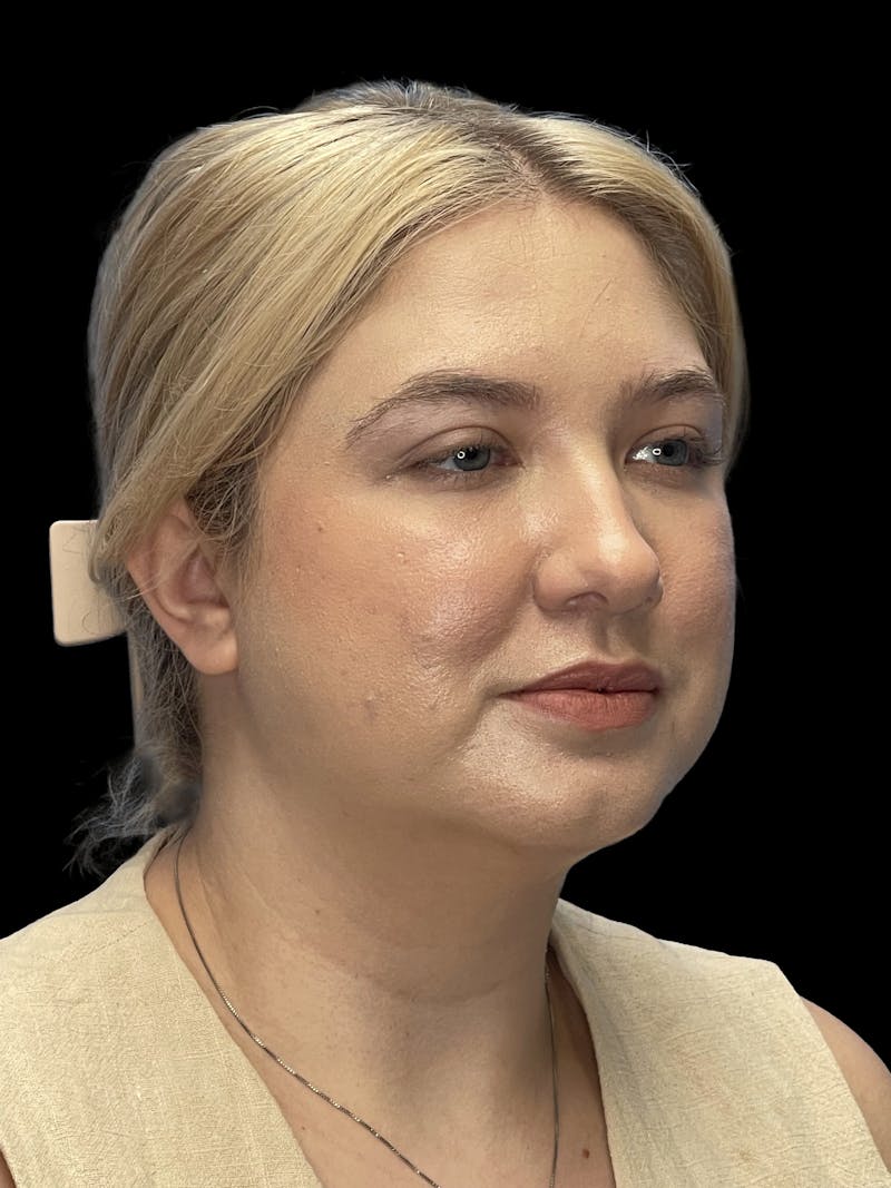 Chin Implant Before & After Gallery - Patient 746472 - Image 6