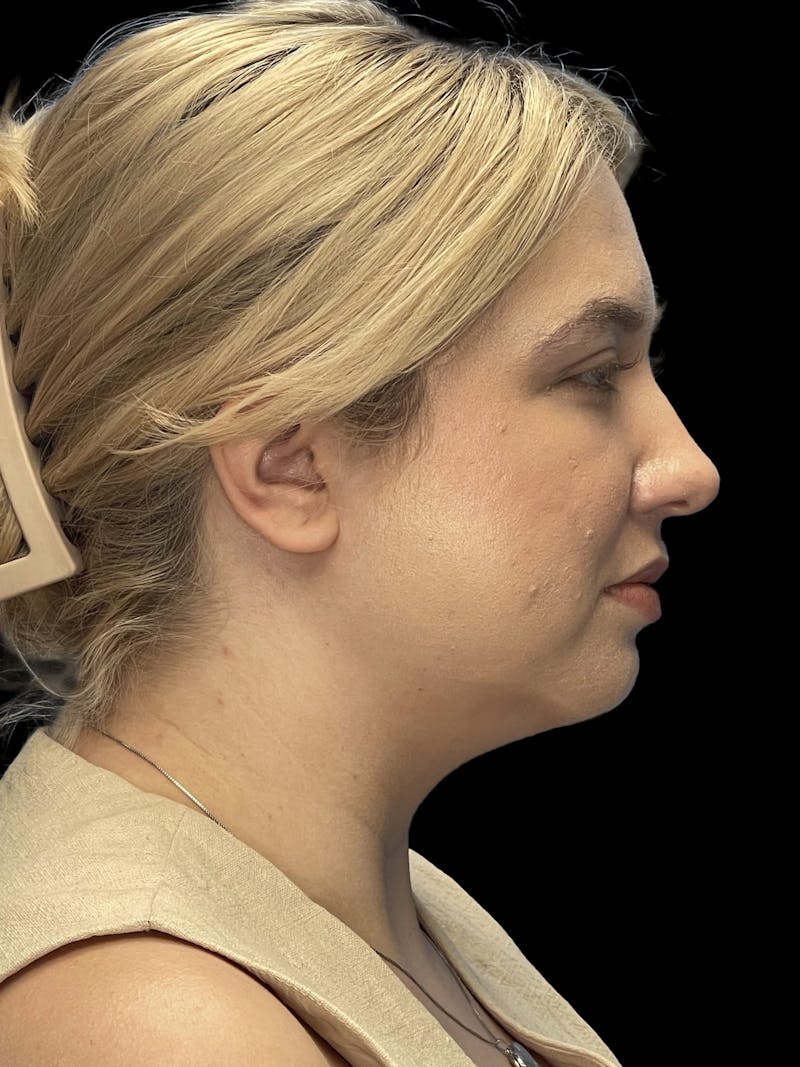 Chin Implant Before & After Gallery - Patient 746472 - Image 10