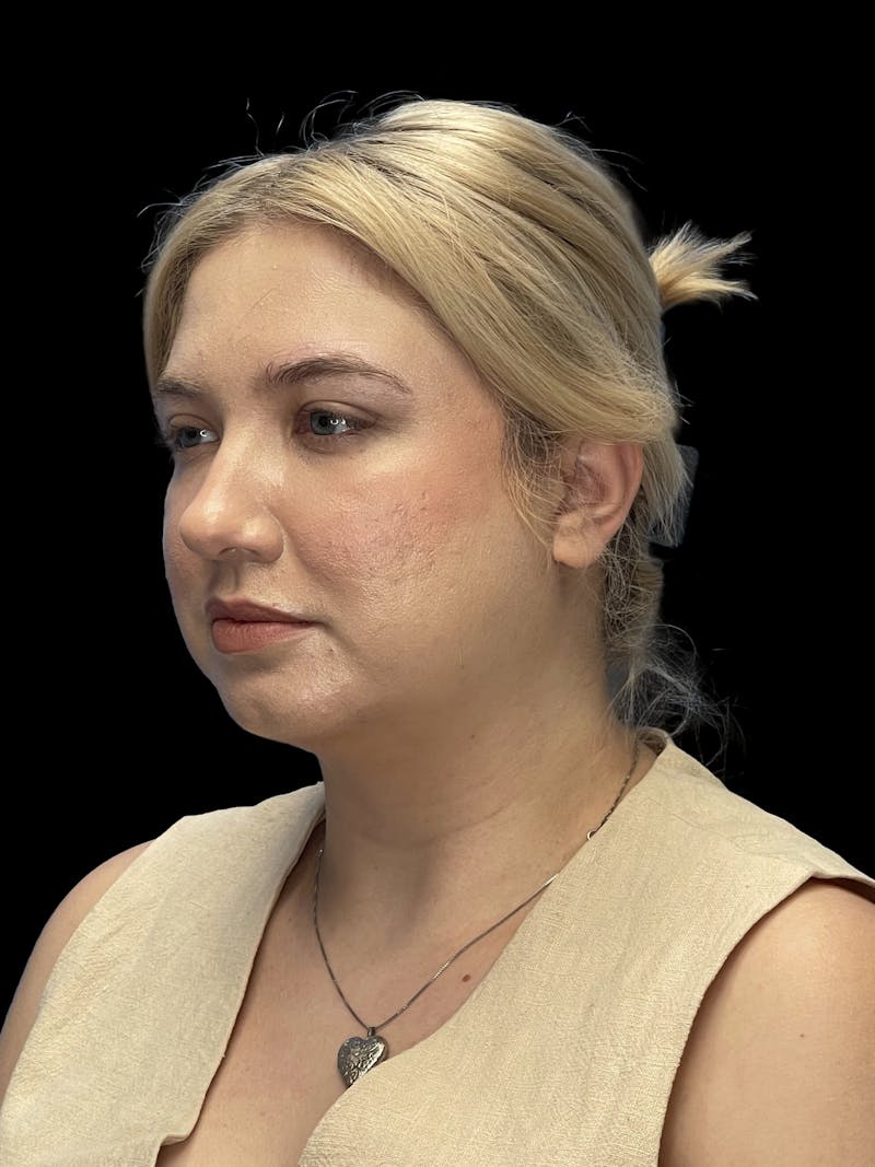 Chin Implant Before & After Gallery - Patient 746472 - Image 4