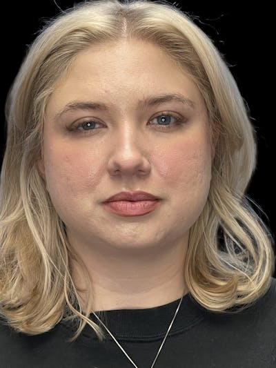 Chin Implant Before & After Gallery - Patient 746472 - Image 1