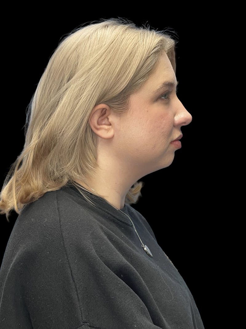 Chin Implant Before & After Gallery - Patient 746472 - Image 9
