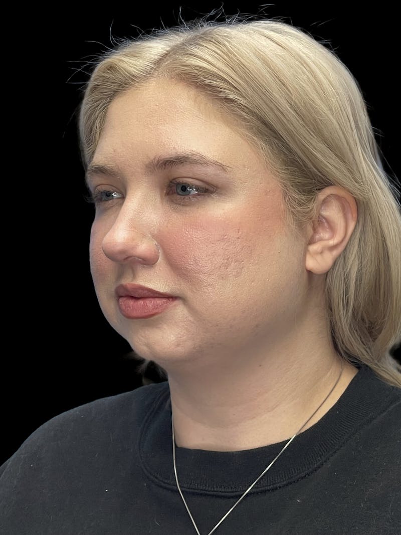 Chin Implant Before & After Gallery - Patient 746472 - Image 3