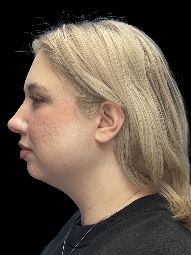 Chin Implant Before & After Gallery - Patient 746472 - Image 7
