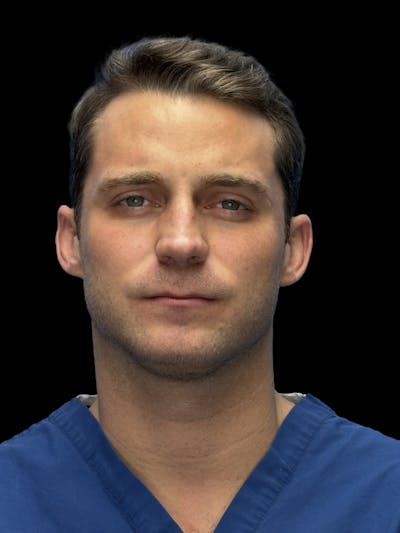 Chin Implant Before & After Gallery - Patient 894724 - Image 1