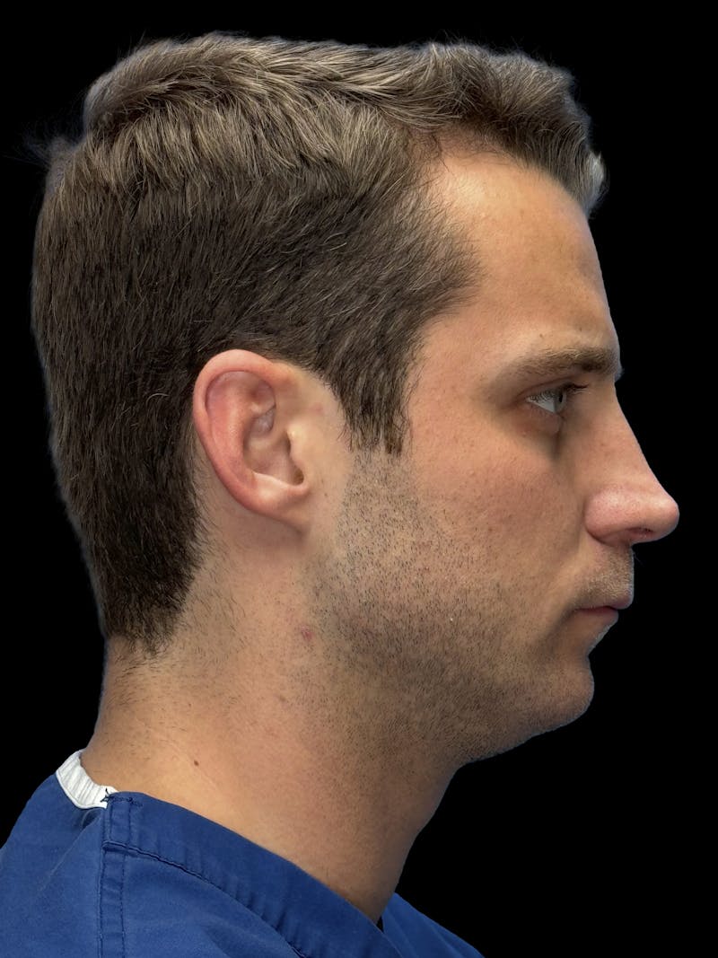 Chin Implant Before & After Gallery - Patient 894724 - Image 7