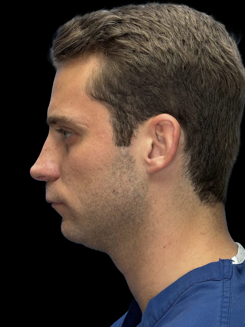 Chin Implant Before & After Gallery - Patient 894724 - Image 3