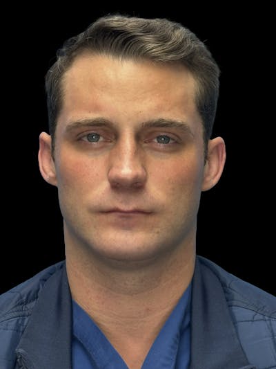 Chin Implant Before & After Gallery - Patient 894724 - Image 2