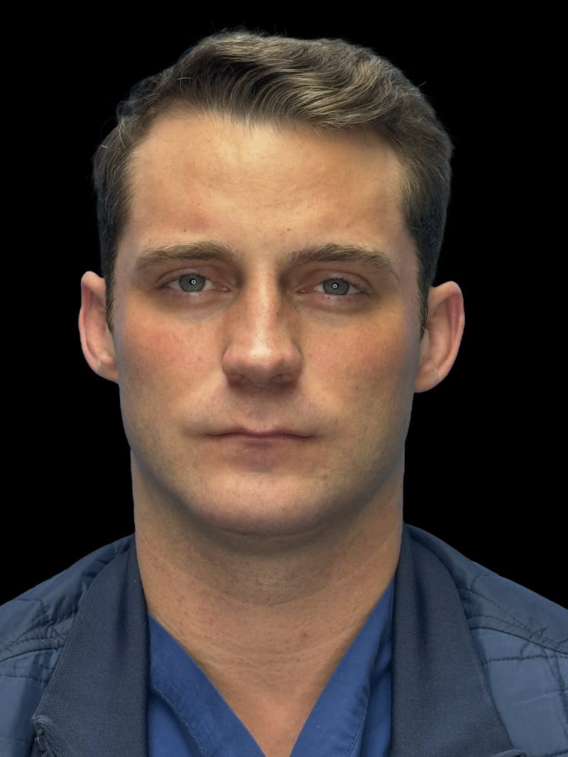 Chin Implant Before & After Gallery - Patient 894724 - Image 2