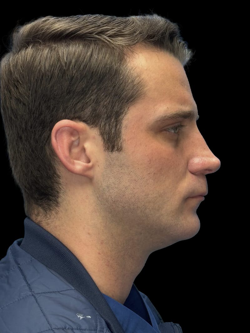Chin Implant Before & After Gallery - Patient 894724 - Image 8
