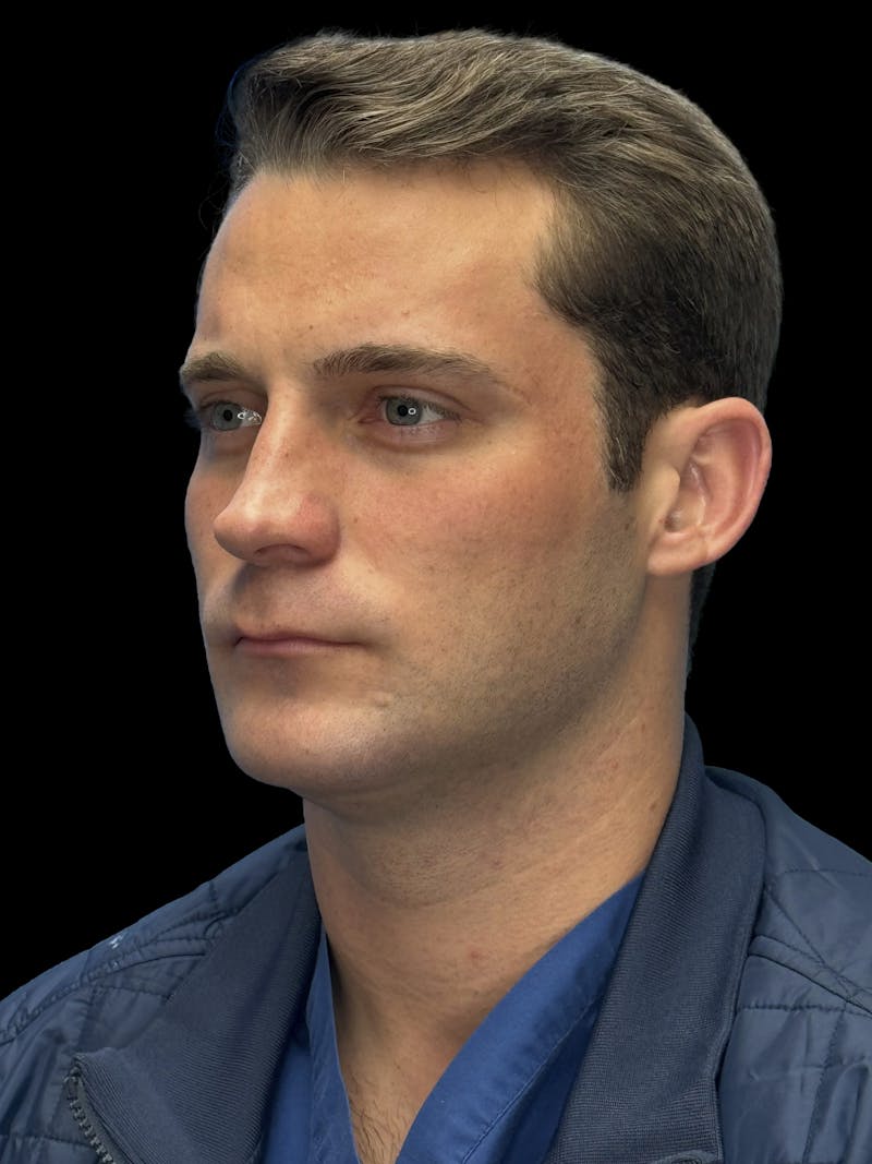 Chin Implant Before & After Gallery - Patient 894724 - Image 6