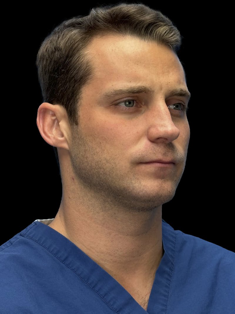 Chin Implant Before & After Gallery - Patient 894724 - Image 9