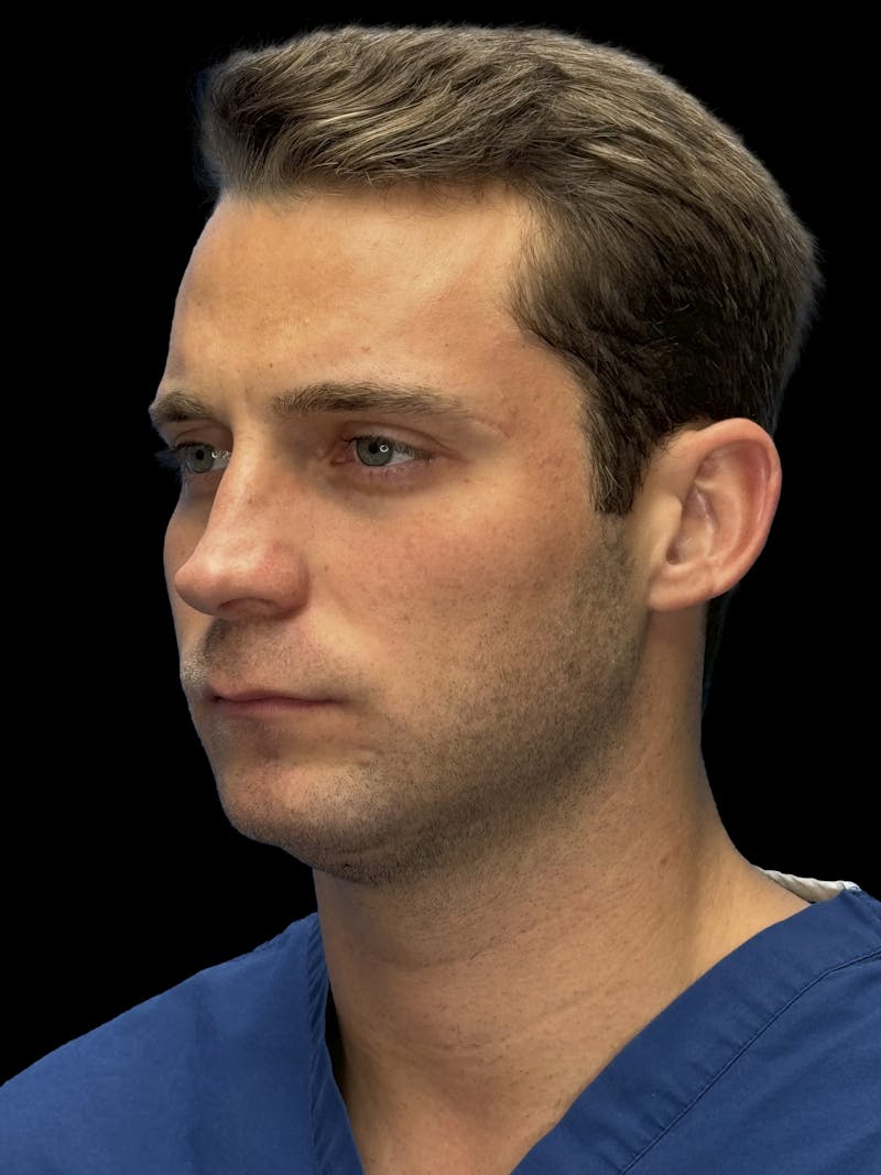Chin Implant Before & After Gallery - Patient 894724 - Image 5