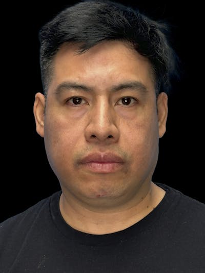 Chin Implant Before & After Gallery - Patient 375006 - Image 1
